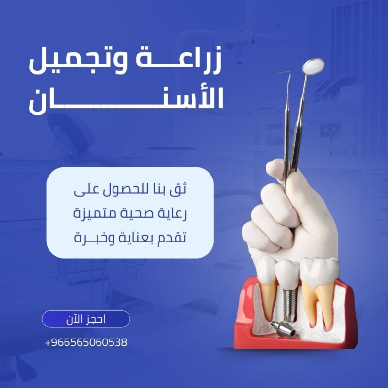 زراعة الاسنان دكتور محمد اسكندر
